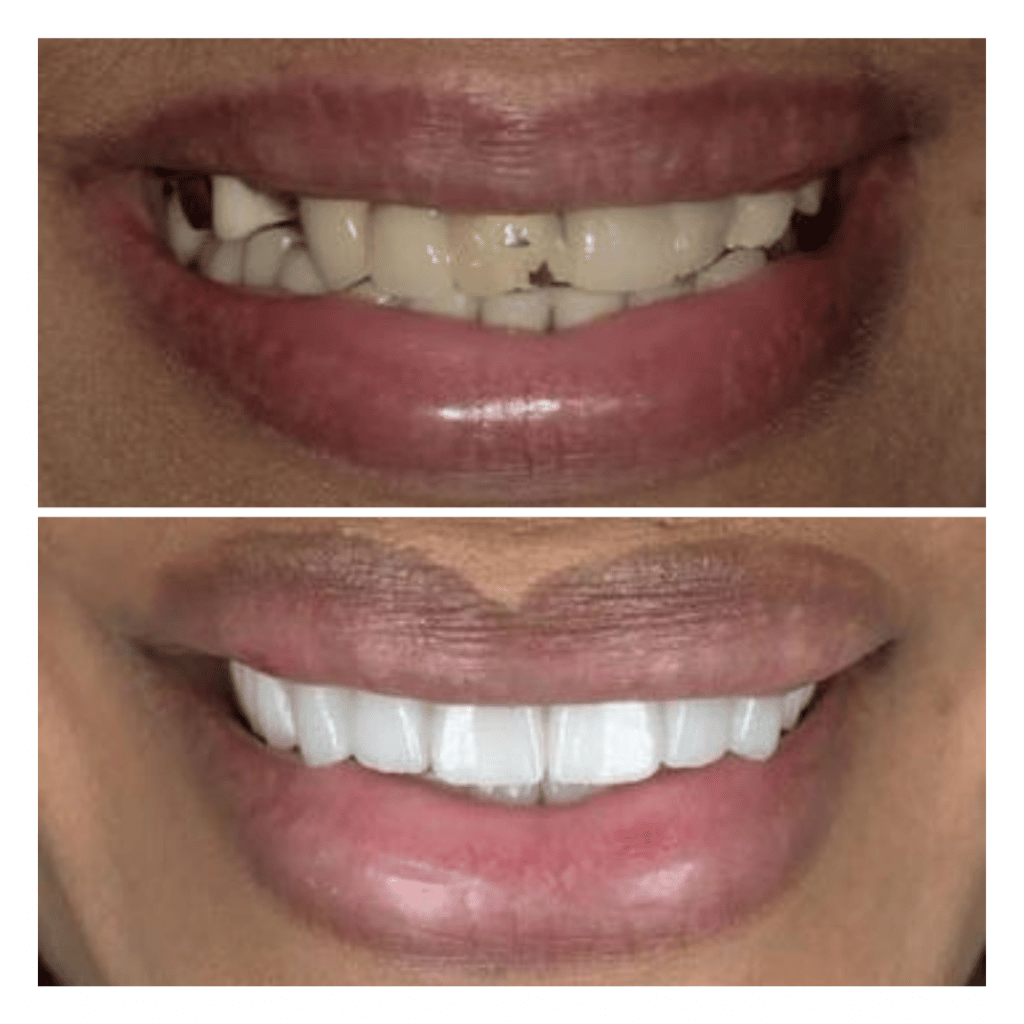 Replacement crown and bridge