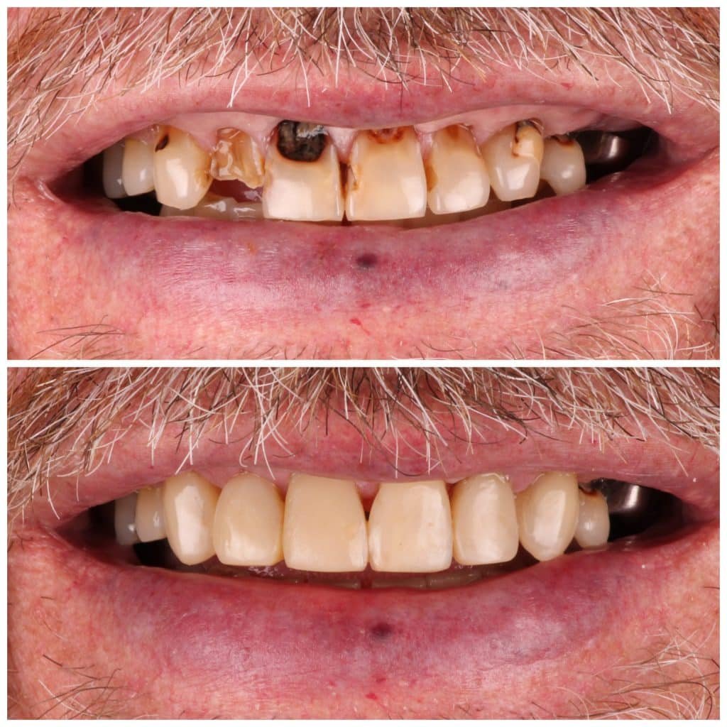 Retiree smile makeover