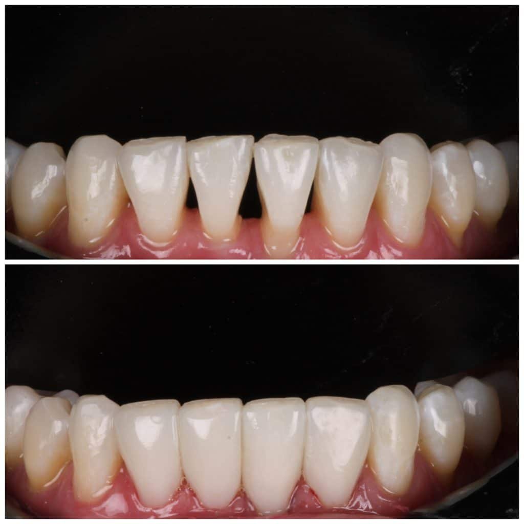 Large Black Triangles with root exposed fixed with the Bioclear Method