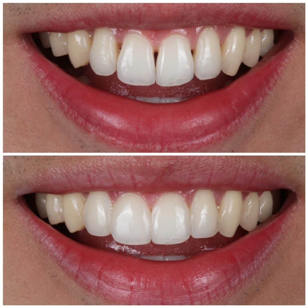 Unusual shaped teeth fixed with the Bioclear Method