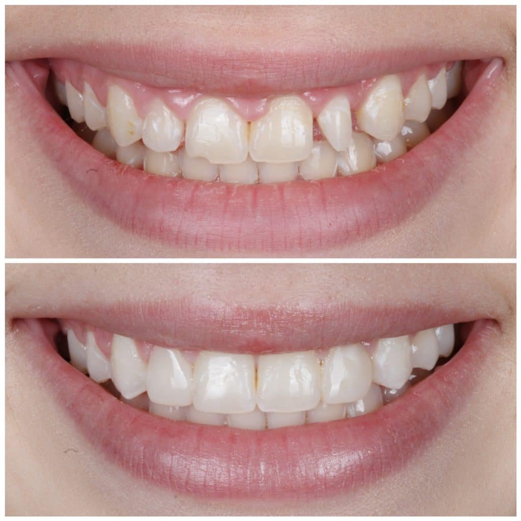 Peg lateral fixed with Bioclear Method