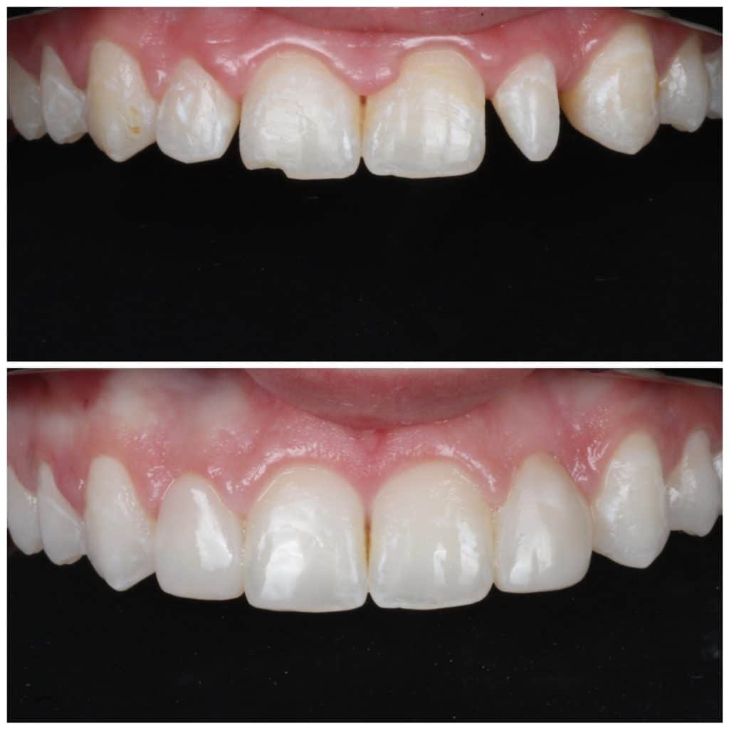 Peg lateral fixed with Bioclear Method
