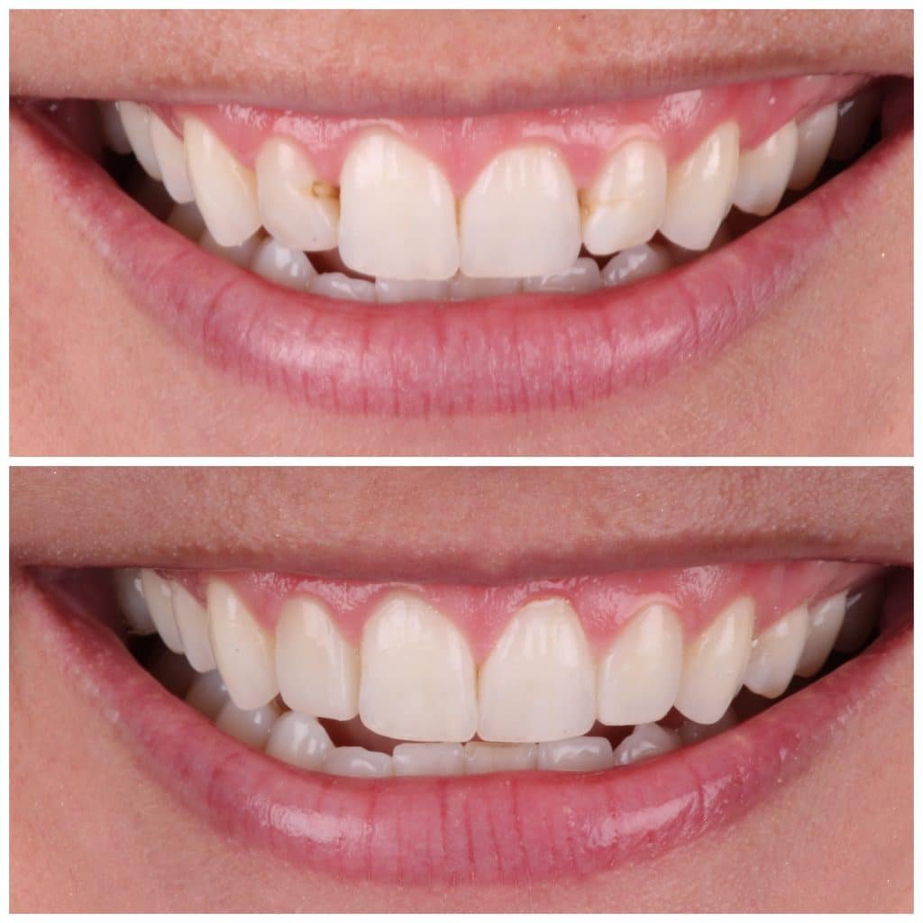 Stained Bonding fixed with composite Veneers