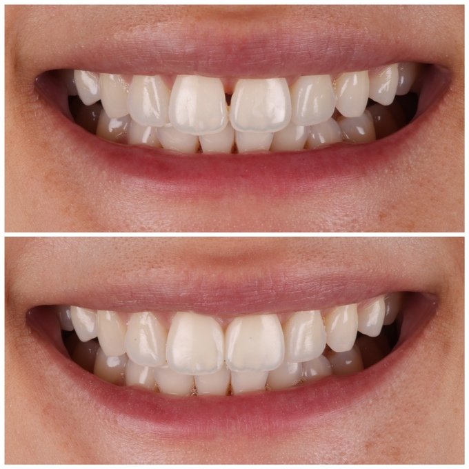 Black Triangle closure with Bioclear
