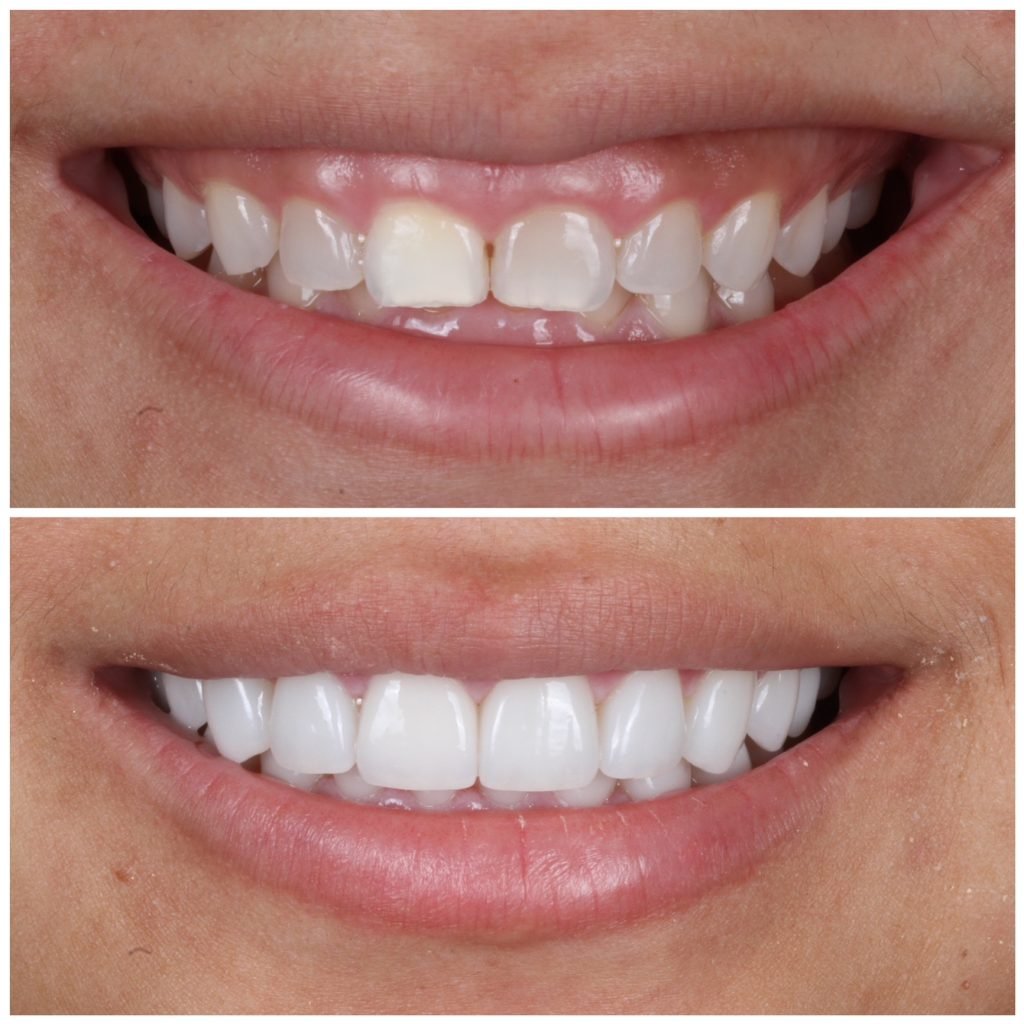 gum lift and porcelain veneers in austin