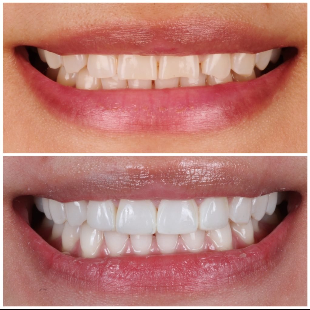 Highlight Veneers