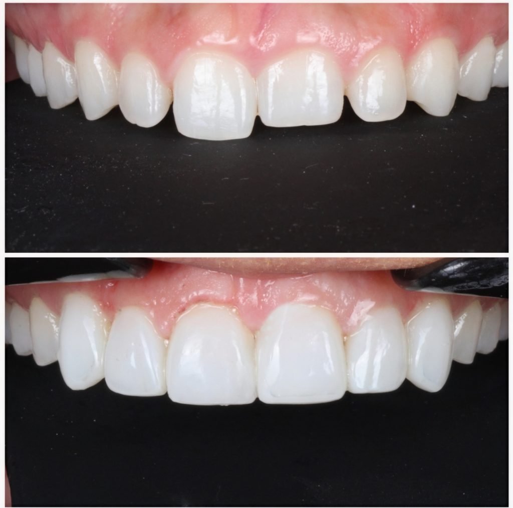Highlight Composite Veneers
