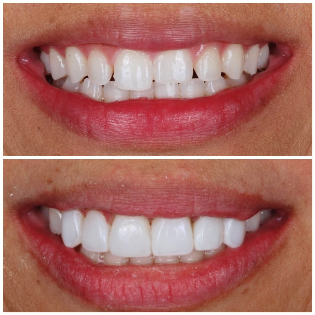 Highlight Composite Veneers