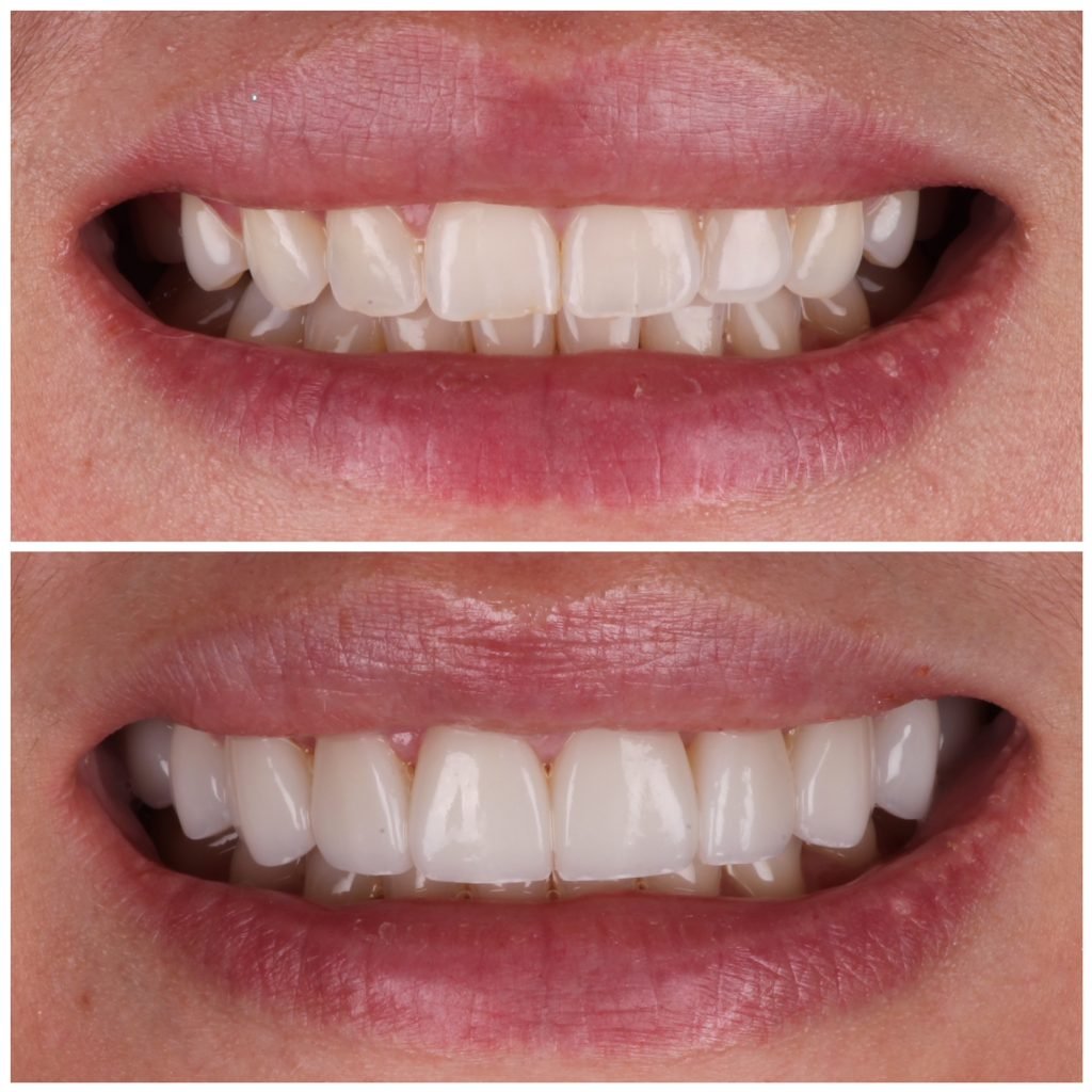 no prep veneers