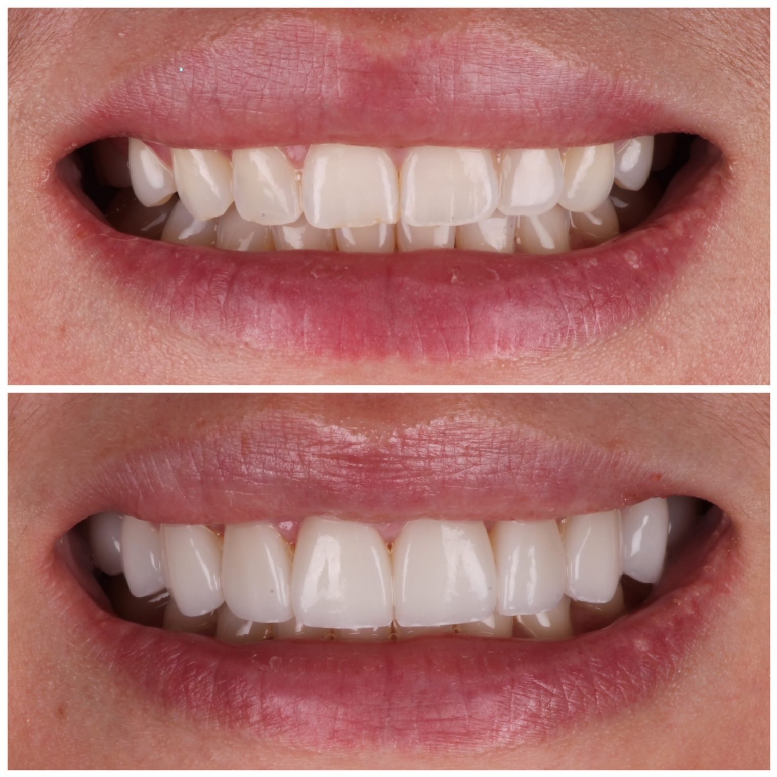 No Prep Veneers Austin Artistic Dental 1 Cosmetic Dentist in Austin